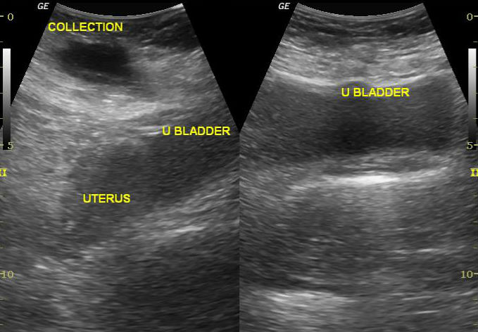 File:Anterior abdominal wall abscess - post LSCS (Radiopaedia 30343-30989 D 1).jpg