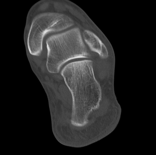 Anterior calcaneal process fracture (Radiopaedia 47384-51989 Coronal bone window 63).png