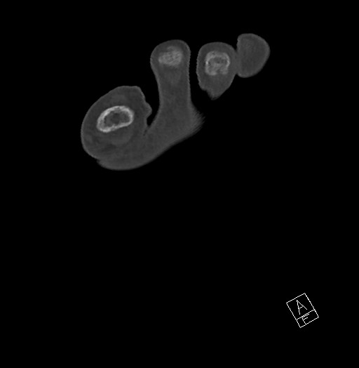 Anterior calcaneal process fracture (Radiopaedia 63353-71943 Axial bone window 28).jpg