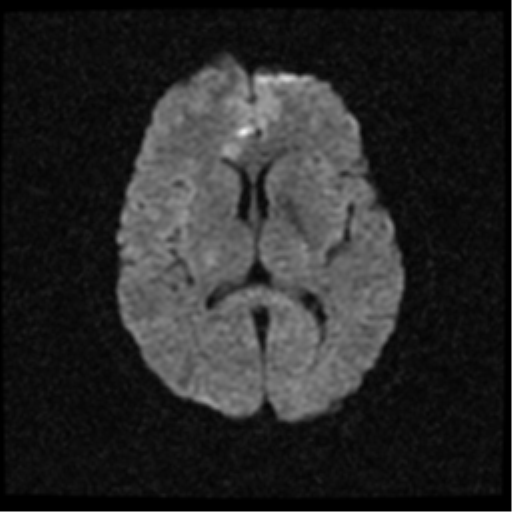 File:Anterior cerebral artery territory infarct (Radiopaedia 39327-41584 Axial DWI 14).png