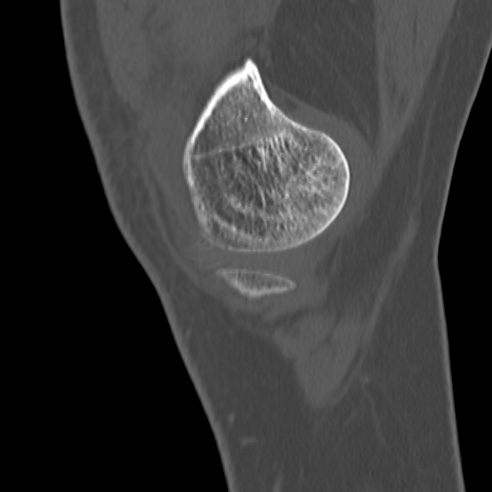 File:Anterior cruciate ligament avulsion fracture (Radiopaedia 58939-66194 Sagittal bone window 36).jpg