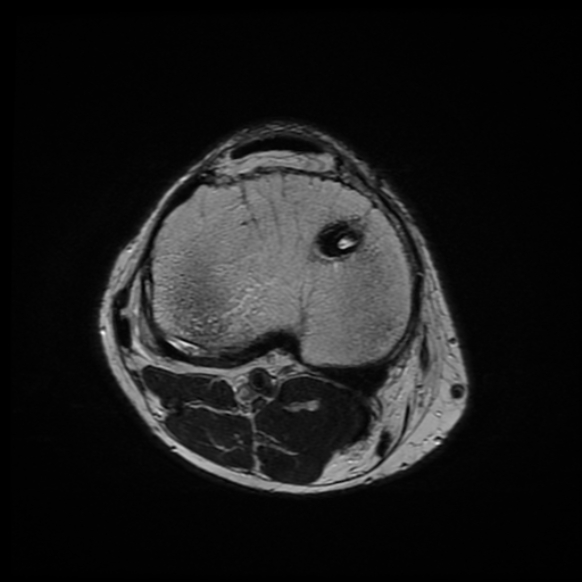 File:Anterior cruciate ligament graft tear and bucket-handle tear of medial meniscus (Radiopaedia 75867-87254 Axial T2 7).jpg