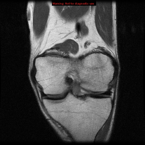 File:Anterior cruciate ligament injury - partial thickness tear (Radiopaedia 12176-12515 D 4).jpg