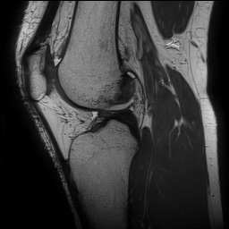 File:Anterior cruciate ligament rupture and posteromedial corner injury (Radiopaedia 67338-76723 Sagittal PD 96).jpg