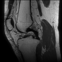 Anterior cruciate ligament rupture with Segond fracture (Radiopaedia 69043-78806 Sagittal PD 89).jpg