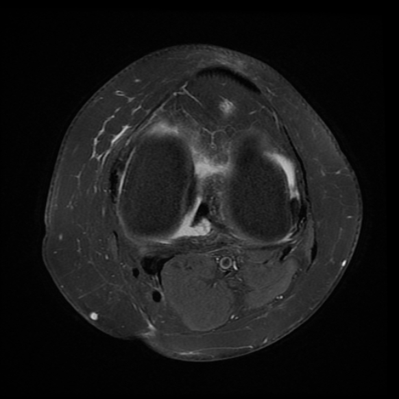 File:Anterior cruciate ligament tear, Wrisberg rip and bucket-handle tear of medial meniscus (Radiopaedia 75872-87266 Axial PD fat sat 12).jpg