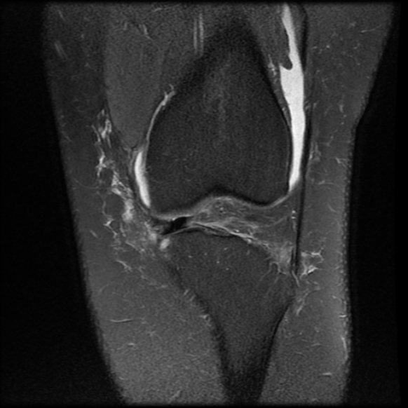 File:Anterior cruciate ligament tear, Wrisberg rip and bucket-handle tear of medial meniscus (Radiopaedia 75872-87266 Coronal PD fat sat 10).jpg