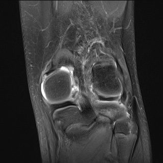 File:Anterior cruciate ligament tear - pediatric (Radiopaedia 62152-70260 Coronal PD fat sat 7).jpg