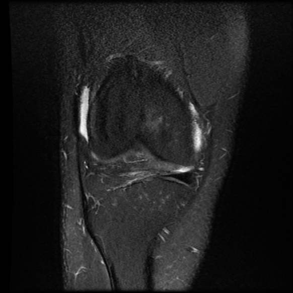 File:Anterior cruciate ligament tear with posteromedial corner injury, bucket-handle meniscal tear and chondral delamination (Radiopaedia 75501-86744 Coronal PD fat sat 8).jpg
