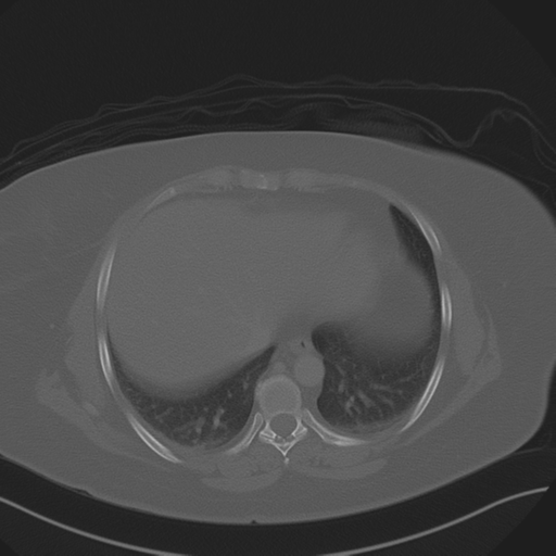 Anterior superior iliac spine avulsion fracture (Radiopaedia 44541-48244 Axial bone window 10).png