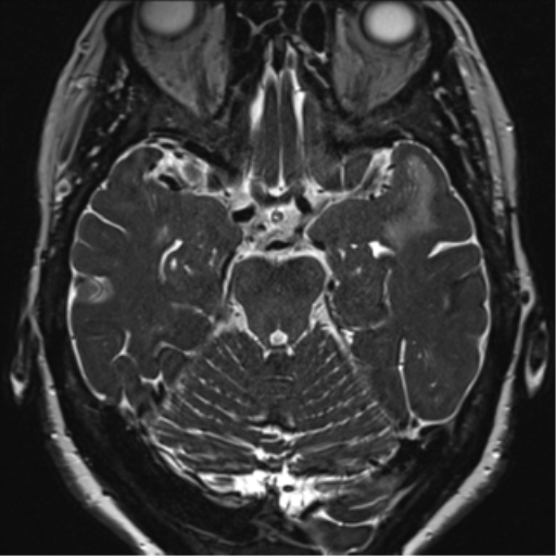 Anterior temporal pole cysts (Radiopaedia 46629-51102 Axial 41).png