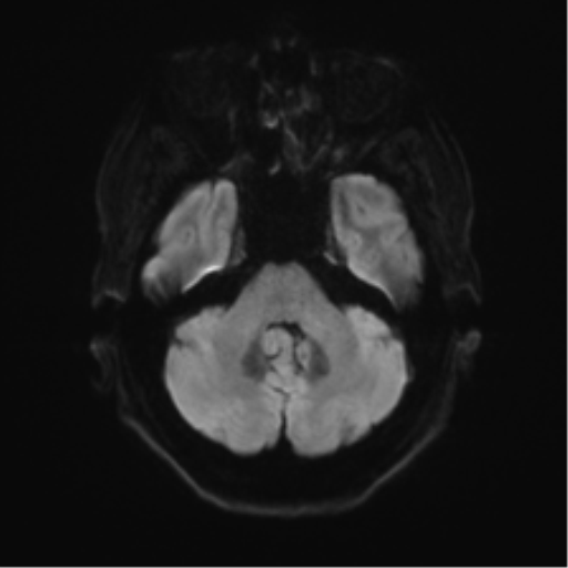 Anterior temporal pole cysts (Radiopaedia 46629-51102 Axial DWI 34).png