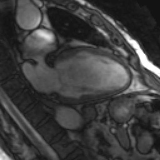 File:Anteroseptal hypokinesia after myocardial infarction (Radiopaedia 15978-15633 2 chamber view SSFE 29).jpg