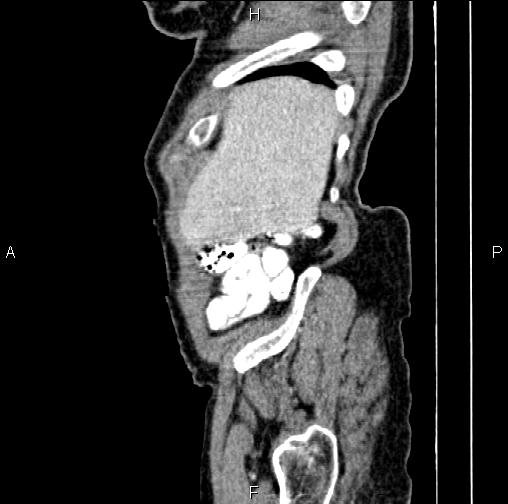 File:Aortic aneurysm and Lemmel syndrome (Radiopaedia 86499-102554 D 7).jpg