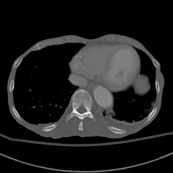 Aortic aneurysm with spinal destruction (Radiopaedia 42301-45410 Axial bone window 4).jpg