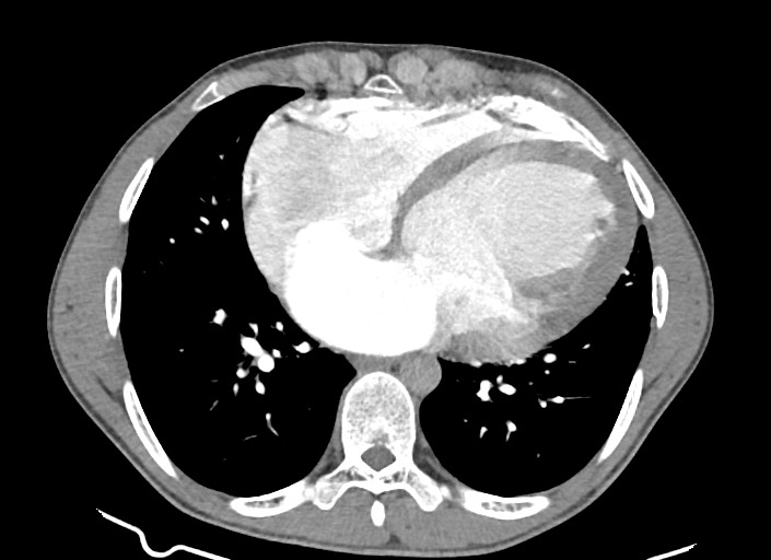 File:Aortic coarctation with aneurysm (Radiopaedia 74818-85828 A 83).jpg