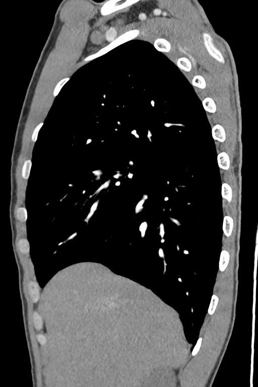Aortic coarctation with aneurysm (Radiopaedia 74818-85828 B 45).jpg