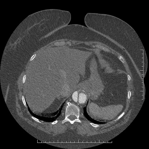 Aortic dissection- Stanford A (Radiopaedia 35729-37268 B 22).jpg
