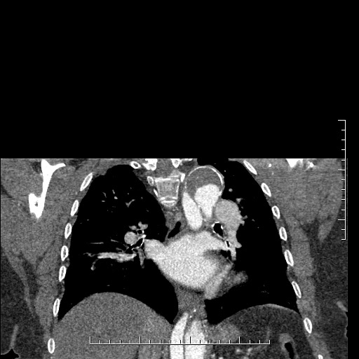 File:Aortic dissection- Stanford A (Radiopaedia 35729-37268 E 15).jpg
