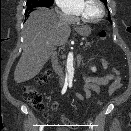 Aortic dissection- Stanford A (Radiopaedia 35729-37268 F 38).jpg