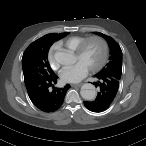 Aortic dissection (Radiopaedia 50763-56234 A 39).png
