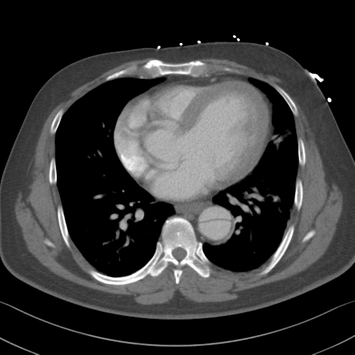 Aortic dissection (Radiopaedia 50763-56234 A 43).png