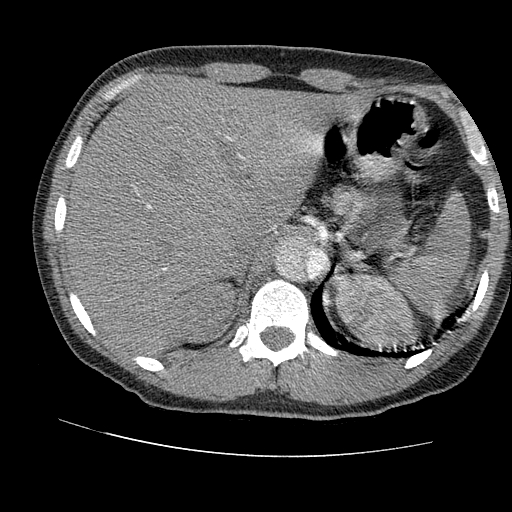 File:Aortic dissection - Stanford A -DeBakey I (Radiopaedia 28339-28587 B 105).jpg