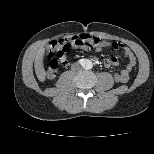 File:Aortic dissection - Stanford A -DeBakey I (Radiopaedia 28339-28587 B 152).jpg