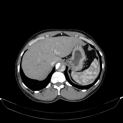 Aortic dissection - Stanford type A (Radiopaedia 83418-98500 A 58).jpg