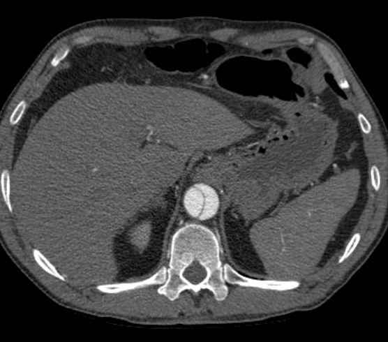 Aortic dissection - Stanford type B (Radiopaedia 73648-84437 A 110).jpg