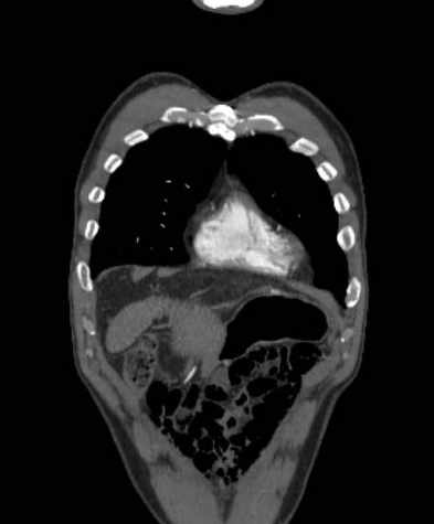 Aortic dissection - Stanford type B (Radiopaedia 73648-84437 B 21).jpg