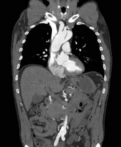 File:Aortic dissection - Stanford type B (Radiopaedia 73648-84437 B 49).jpg