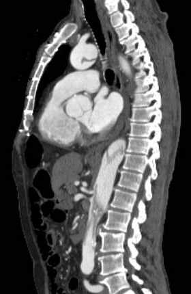 File:Aortic dissection - Stanford type B (Radiopaedia 73648-84437 C 72).jpg