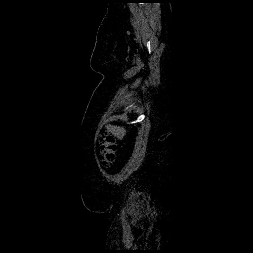 Aortic dissection - Stanford type B (Radiopaedia 88281-104910 C 3).jpg