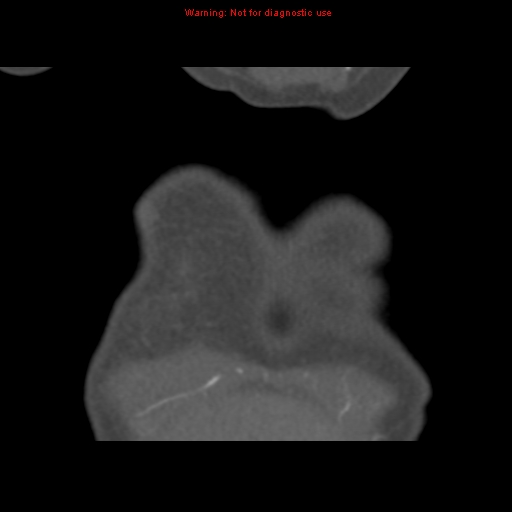 File:Aortic ductus diverticulum (Radiopaedia 8339-9180 B 4).jpg