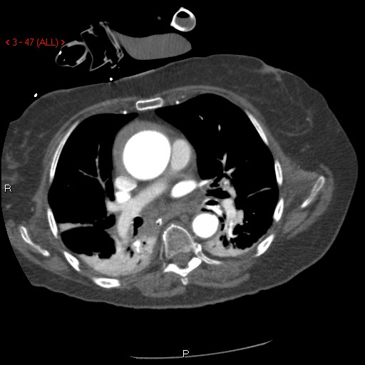 Aortic intramural hematoma (Radiopaedia 27746-28001 A 47).jpg