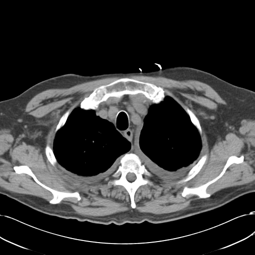 Aortic intramural hematoma (Radiopaedia 34260-35540 Axial non-contrast 12).png
