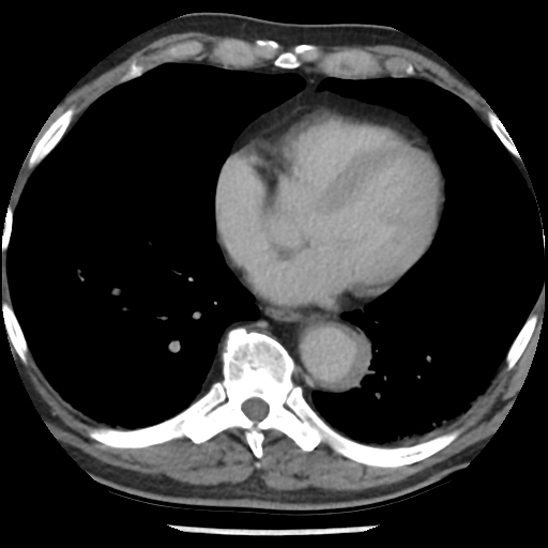 Aortic intramural hematoma (type B) (Radiopaedia 79323-92387 Axial C+ delayed 36).jpg