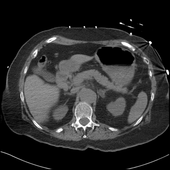 Aortic intramural hematoma with dissection and intramural blood pool (Radiopaedia 77373-89491 Axial non-contrast 102).jpg