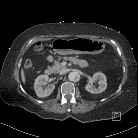 Aortic intramural hematoma with dissection and intramural blood pool (Radiopaedia 77373-89491 E 23).jpg