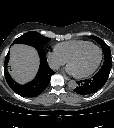 File:Aortic valve endocarditis (Radiopaedia 87209-103485 Axial non-contrast 71).jpg