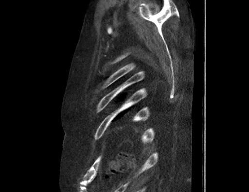 Aortoesophageal fistula with endovascular repair (Radiopaedia 73781-84592 Sagittal C+ CTPA 185).jpg