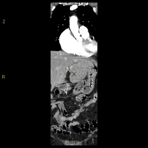File:Aortoiliac occlusive disease (Radiopaedia 16828-16548 B 22).jpg