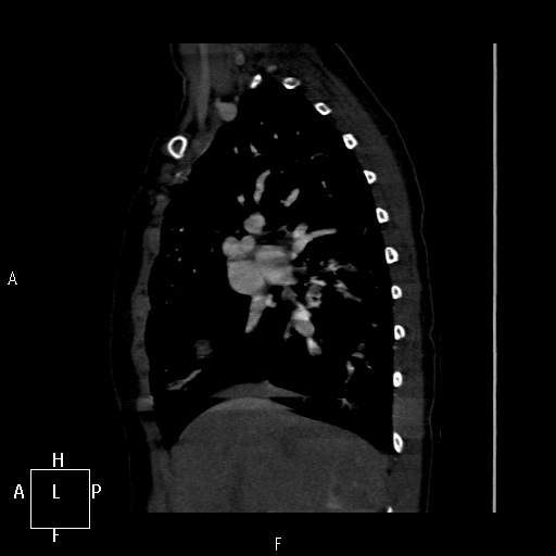 File:Aortopulmonary septal defect (Radiopaedia 41990-45013 Sagittal C+ CTPA 43).jpg