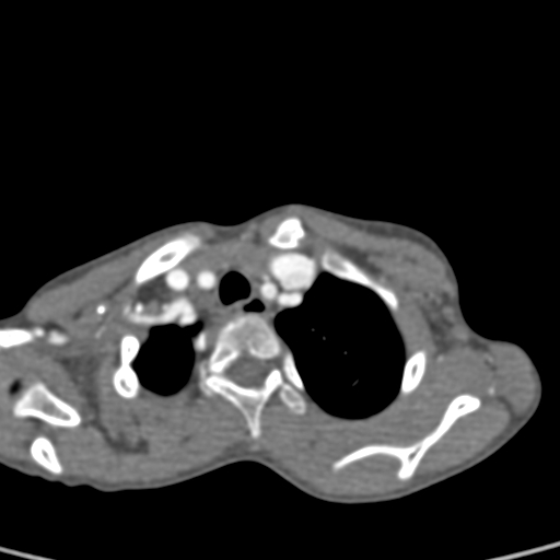 File:Aortopulmonary window, interrupted aortic arch and large PDA giving the descending aorta (Radiopaedia 35573-37074 B 11).jpg