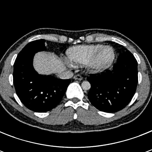 Apical lung mass mimic - neurogenic tumor (Radiopaedia 59918-67521 A 62).jpg