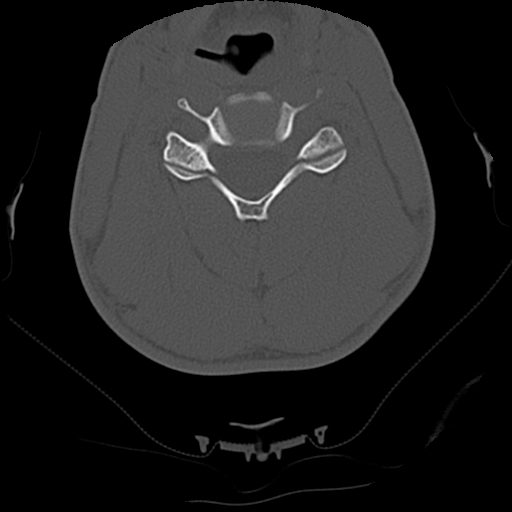 File:Apical pneumothorax on cervical spine CT (Radiopaedia 45343-49368 Axial bone window 47).jpg