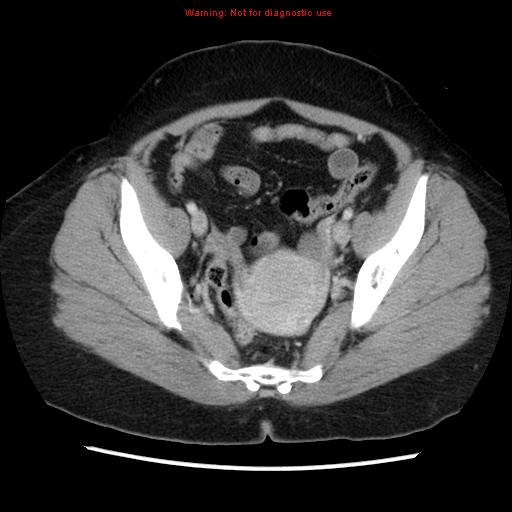 Appendiceal mucinous cystadenoma (Radiopaedia 8263-9111 Axial liver window 67).jpg