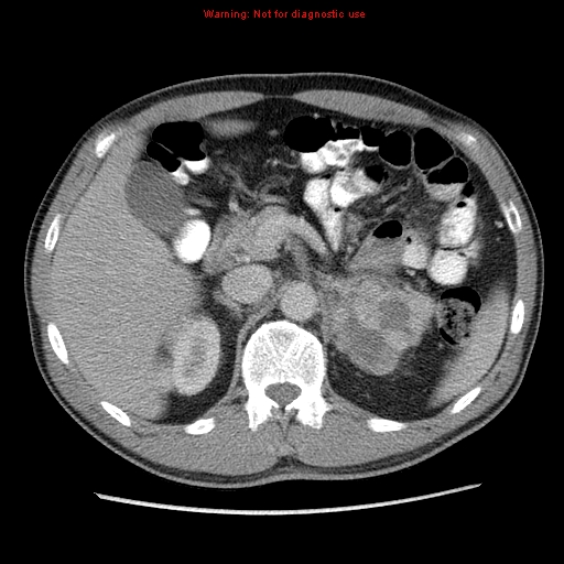 File:Appendicitis and renal cell carcinoma (Radiopaedia 17063-16760 A 17).jpg