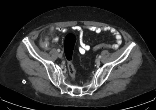 File:Appendicitis due to chicken fibula (Radiopaedia 74314-85198 A 31).jpg